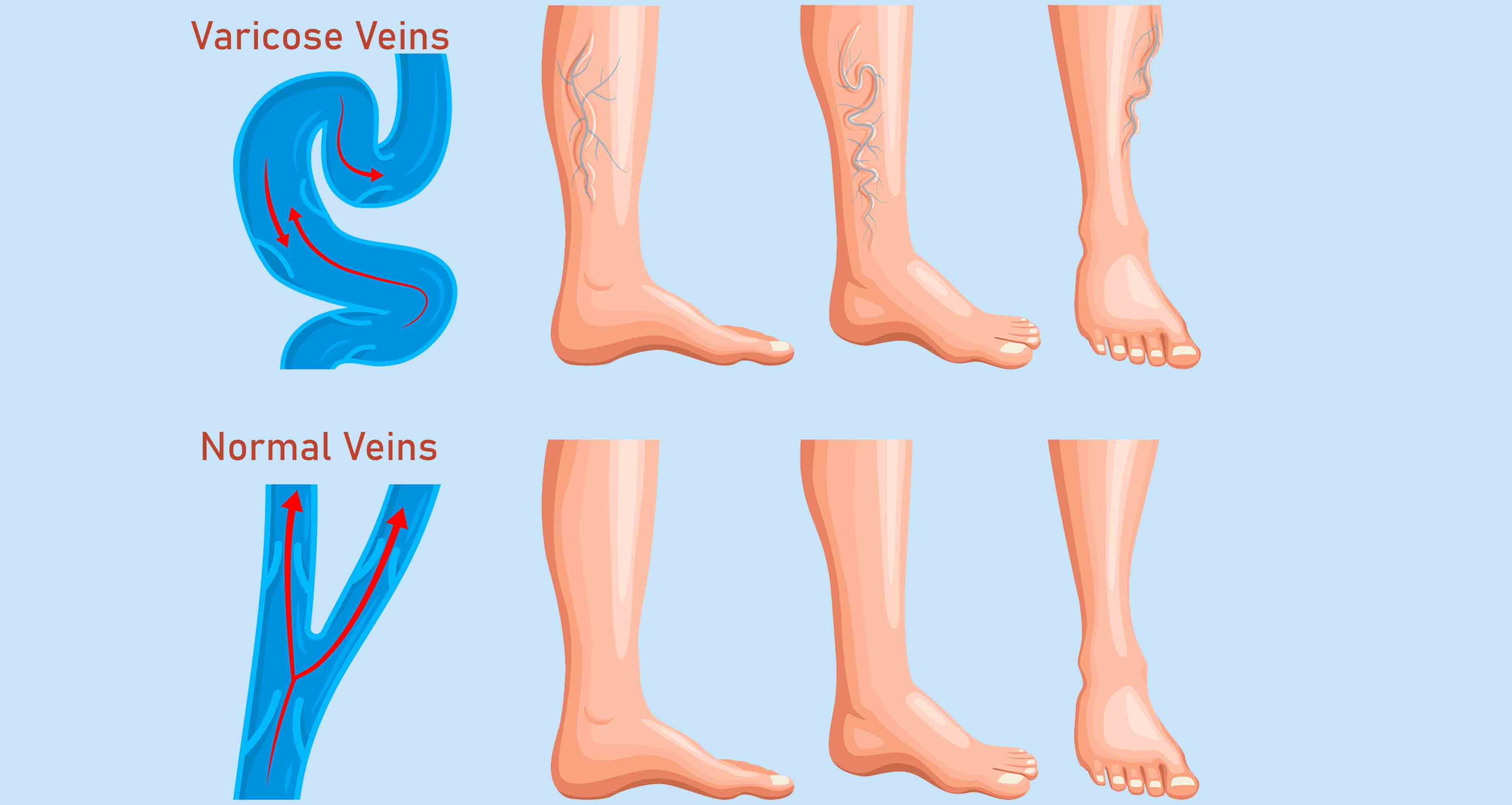 varicose veins vs normal veins